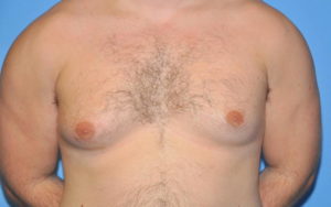 Gynecomastia Before and After Pictures Plano, TX