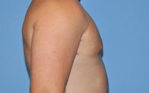 Gynecomastia Before and After Pictures Plano, TX