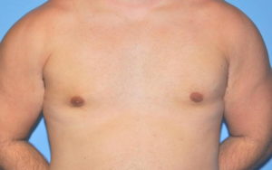 Gynecomastia Before and After Pictures Plano, TX