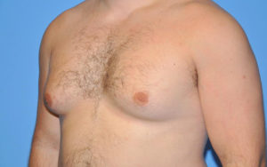 Gynecomastia Before and After Pictures Plano, TX