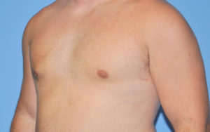 Gynecomastia Before and After Pictures Plano, TX