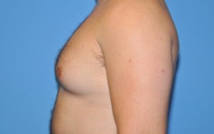 Gynecomastia Before and After Pictures Plano, TX