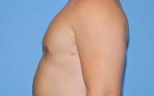 Gynecomastia Before and After Pictures Plano, TX