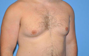 Gynecomastia Before and After Pictures Plano, TX