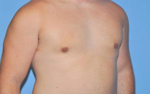 Gynecomastia Before and After Pictures Plano, TX