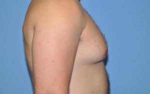 Gynecomastia Before and After Pictures Plano, TX