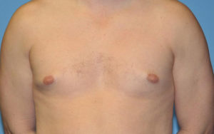 Gynecomastia Before and After Pictures Plano, TX