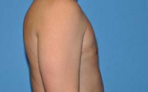 Gynecomastia Before and After Pictures Plano, TX