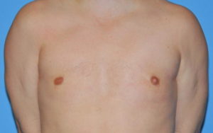 Gynecomastia Before and After Pictures Plano, TX