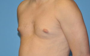 Gynecomastia Before and After Pictures Plano, TX