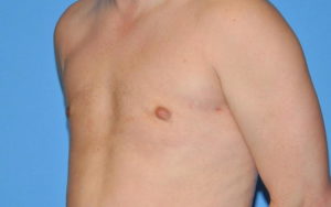 Gynecomastia Before and After Pictures Plano, TX