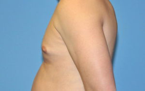 Gynecomastia Before and After Pictures Plano, TX