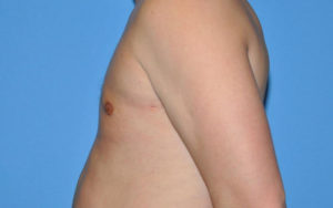 Gynecomastia Before and After Pictures Plano, TX