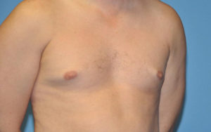 Gynecomastia Before and After Pictures Plano, TX