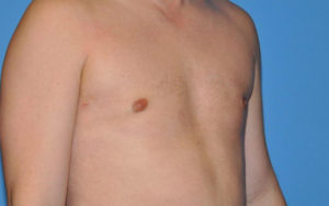 Gynecomastia Before and After Pictures Plano, TX