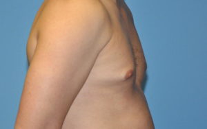 Gynecomastia Before and After Pictures Plano, TX