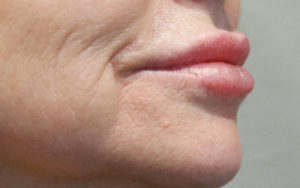 Injectables/Fillers Before and After Pictures Plano, TX