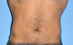 Liposuction Before and After Pictures Plano, TX