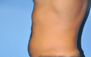 Liposuction Before and After Pictures Plano, TX