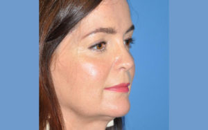 Rhinoplasty Before and After Pictures Plano, TX