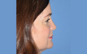 Rhinoplasty Before and After Pictures Plano, TX