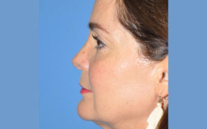 Rhinoplasty Before and After Pictures Plano, TX