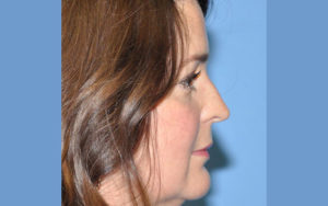 Rhinoplasty Before and After Pictures Plano, TX