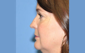 Rhinoplasty Before and After Pictures Plano, TX