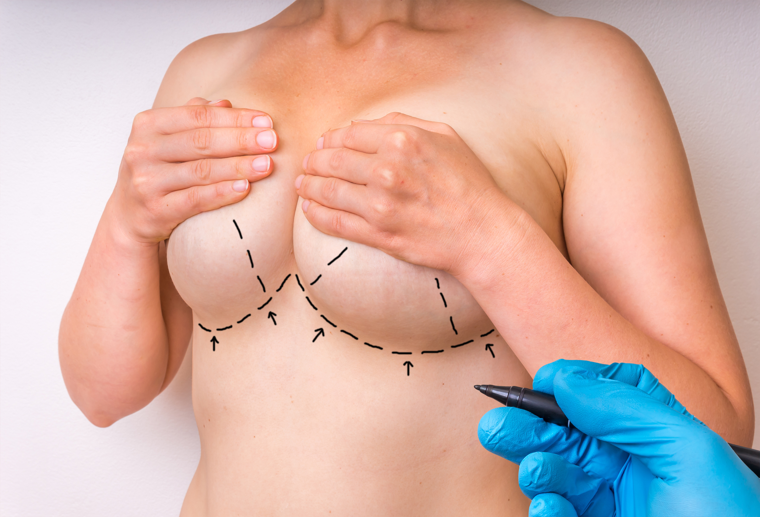 Breast Reduction in Plano, TX