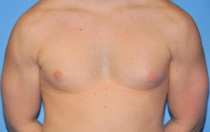 Gynecomastia Before and After Pictures Plano, TX