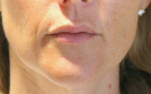 Lip Injection Before and After Pictures Plano, TX