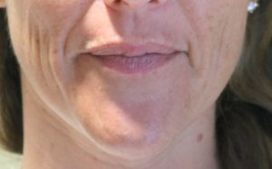 Facial Filler Before and After Pictures Plano, TX