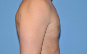 Gynecomastia Before and After Pictures Plano, TX