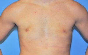 Gynecomastia Before and After Pictures Plano, TX