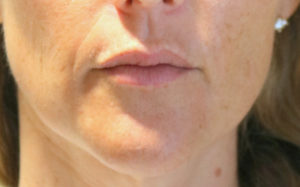 Facial Filler Before and After Pictures Plano, TX