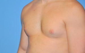 Gynecomastia Before and After Pictures Plano, TX