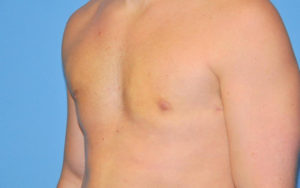 Gynecomastia Before and After Pictures Plano, TX