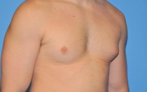 Gynecomastia Before and After Pictures Plano, TX