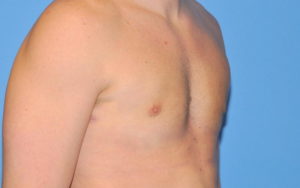 Gynecomastia Before and After Pictures Plano, TX