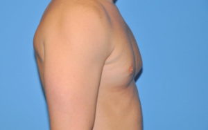 Gynecomastia Before and After Pictures Plano, TX