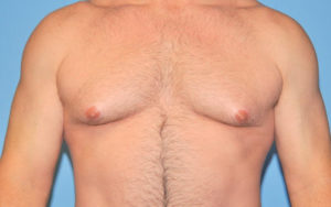 Gynecomastia Before and After Pictures Plano, TX