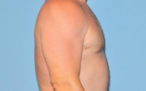 Gynecomastia Before and After Pictures Plano, TX