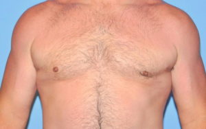Gynecomastia Before and After Pictures Plano, TX