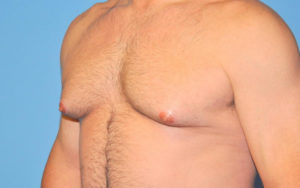 Gynecomastia Before and After Pictures Plano, TX