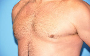 Gynecomastia Before and After Pictures Plano, TX