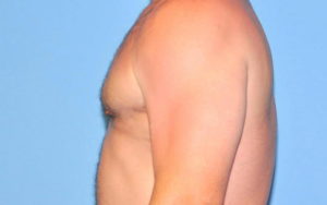 Gynecomastia Before and After Pictures Plano, TX