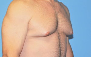 Gynecomastia Before and After Pictures Plano, TX