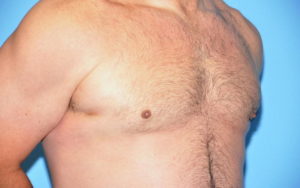 Gynecomastia Before and After Pictures Plano, TX