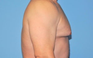 Gynecomastia Before and After Pictures Plano, TX