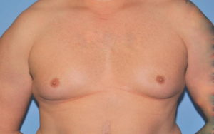 Gynecomastia Before and After Pictures Plano, TX